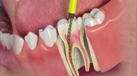 عصب کشی دندان(درمان ریشه)