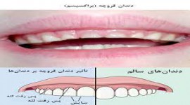 دندان قروچه چه معایبی دارد و چگونه درمان می شود؟