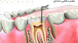 عصب کشی دندان جلو چیست و چگونه انجام می شود؟