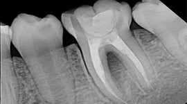 رادیوگرافی-دندان