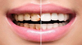 آیا دندان عصب کشی شده را می توان لمینیت کرد؟