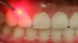 لیزر دندان چیست و چه کاربردی دارد؟
